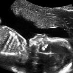ultrasound-20-week-2d